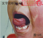 血管瘤病理图片图121-图140(图15)