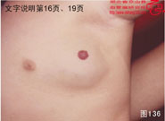 血管瘤病理图片图121-图140(图16)