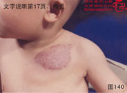 血管瘤病理图片图121-图140(图20)