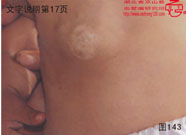 血管瘤病理图片图141-图160(图3)