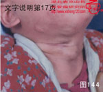 血管瘤病理图片图141-图160(图4)