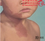 血管瘤病理图片图141-图160(图6)