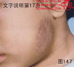 血管瘤病理图片图141-图160(图7)