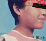 血管瘤病理图片图141-图160(图9)