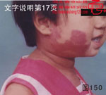 血管瘤病理图片图141-图160(图10)