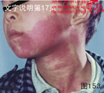 血管瘤病理图片图141-图160(图13)