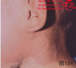 血管瘤病理图片图141-图160(图14)