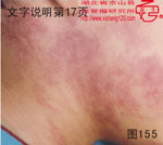 血管瘤病理图片图141-图160(图15)