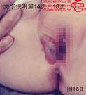 血管瘤病理图片图161-图180(图2)