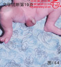 血管瘤病理图片图161-图180(图3)