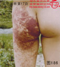 血管瘤病理图片图181-图200(图5)