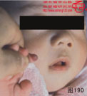 血管瘤病理图片图181-图200(图9)