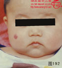 血管瘤病理图片图181-图200(图11)