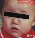 血管瘤病理图片图181-图200(图12)