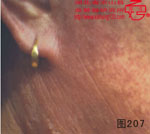 血管瘤病理图片图201-图220(图6)