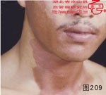 血管瘤病理图片图201-图220(图8)