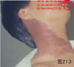 血管瘤病理图片图201-图220(图12)