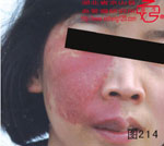 血管瘤病理图片图201-图220(图13)
