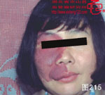 血管瘤病理图片图201-图220(图14)