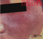 血管瘤病理图片图201-图220(图15)