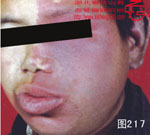 血管瘤病理图片图201-图220(图16)