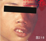 血管瘤病理图片图201-图220(图17)