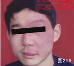 血管瘤病理图片图201-图220(图18)