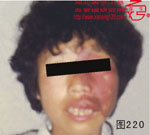 血管瘤病理图片图201-图220(图19)