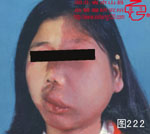 血管瘤病理图片图221-图240(图1)