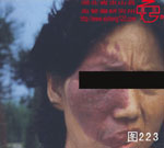 血管瘤病理图片图221-图240(图2)