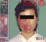 血管瘤病理图片图221-图240(图4)