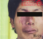 血管瘤病理图片图221-图240(图5)