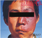 血管瘤病理图片图221-图240(图6)