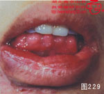 血管瘤病理图片图221-图240(图8)