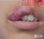 血管瘤病理图片图221-图240(图9)