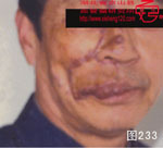 血管瘤病理图片图221-图240(图12)