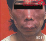 血管瘤病理图片图221-图240(图13)