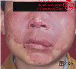 血管瘤病理图片图221-图240(图14)