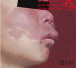 血管瘤病理图片图221-图240(图15)