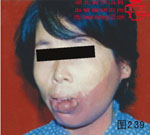 血管瘤病理图片图221-图240(图18)