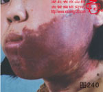 血管瘤病理图片图221-图240(图19)