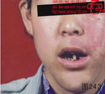 血管瘤病理图片图241-图260(图3)
