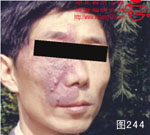 血管瘤病理图片图241-图260(图4)