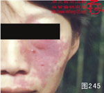 血管瘤病理图片图241-图260(图5)