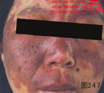 血管瘤病理图片图241-图260(图7)