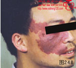 血管瘤病理图片图241-图260(图8)