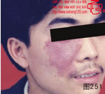 血管瘤病理图片图241-图260(图11)