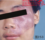 血管瘤病理图片图241-图260(图13)