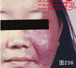 血管瘤病理图片图241-图260(图16)