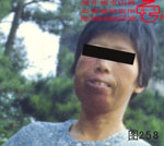 血管瘤病理图片图241-图260(图18)